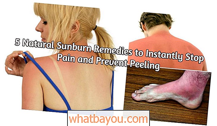 5 natuurlijke zonnebrandmiddelen om pijn onmiddellijk te stoppen en peeling te voorkomen