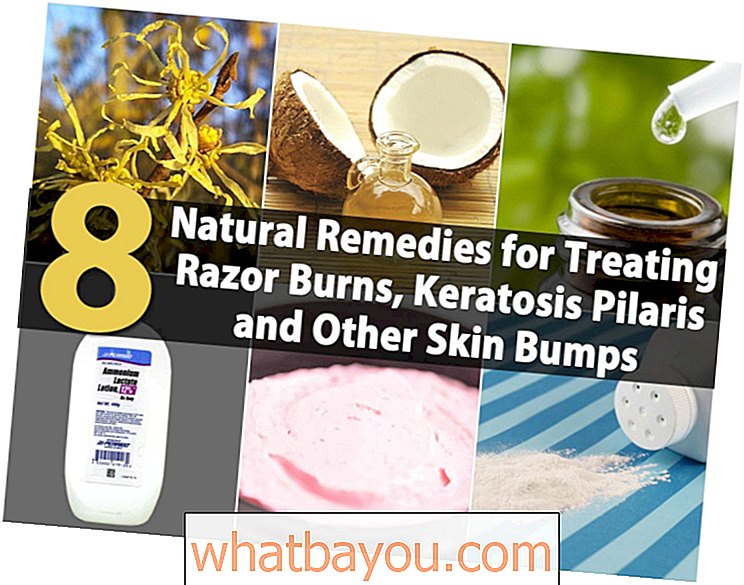 Здравље: 8 природних лекова за лечење опекотина од бријача, кератозе пиларис и других израслина на кожи